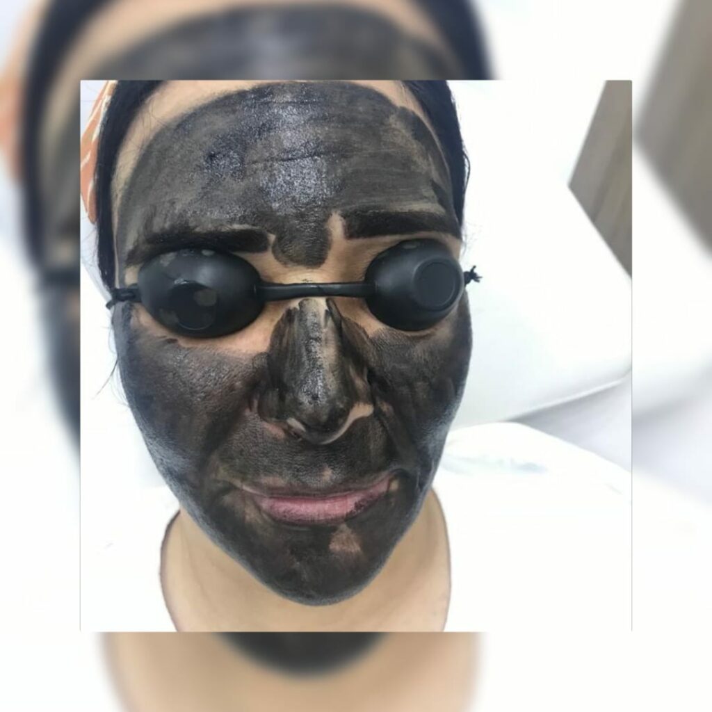 Carbon laser session to smooth the skin